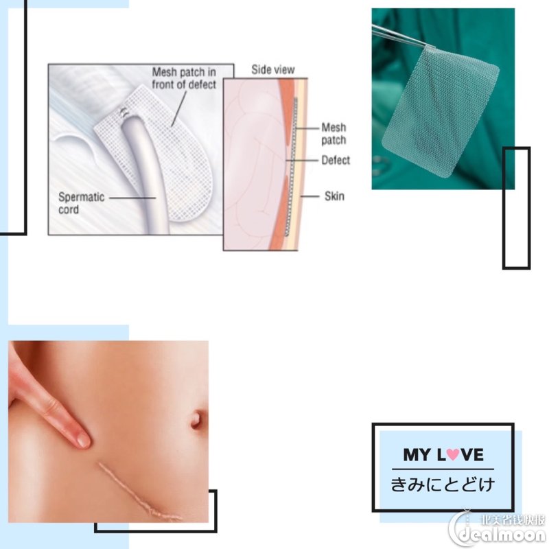 儿童腹股沟疝气修补手术