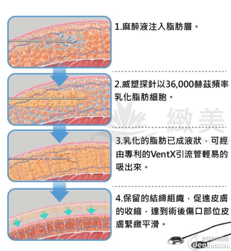 扒皮纽约超模圈的抽脂黑科技vaser lipo!