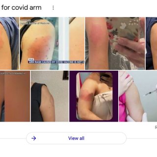 什么是COVID arm｜迟来的疫苗副作...