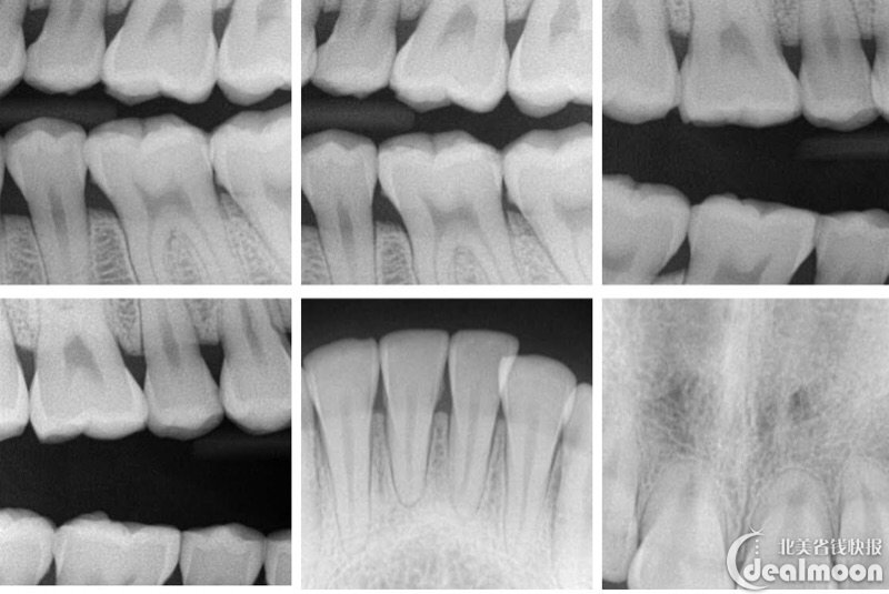 部分牙齿x光片
