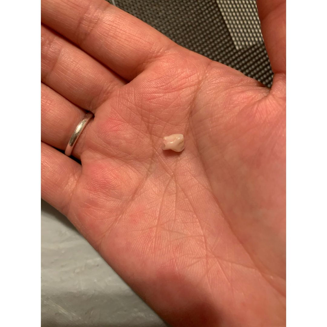 小孩子的牙齿要掉了,我就顺手拔了一下就马上掉下来了   猜你喜欢  加