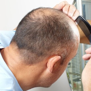 脱发星人必看！皮肤科医生揭秘：这些方法真能救你的发际线！