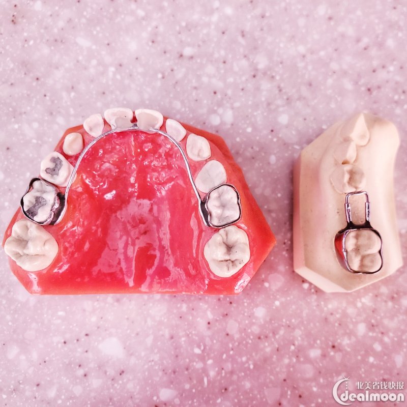 小朋友乳牙早失带的间隙保持器(左为前牙 右为后牙)