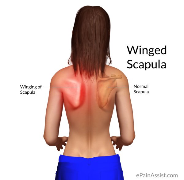 scapular winging :靠近脊柱侧与下侧都突起