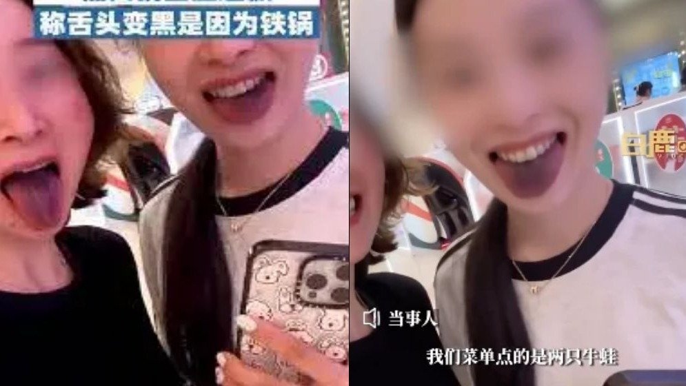 亚硝酸盐攻略 - 母女俩吃火锅后舌头变黑似中毒！症状、后遗症、如何解救！