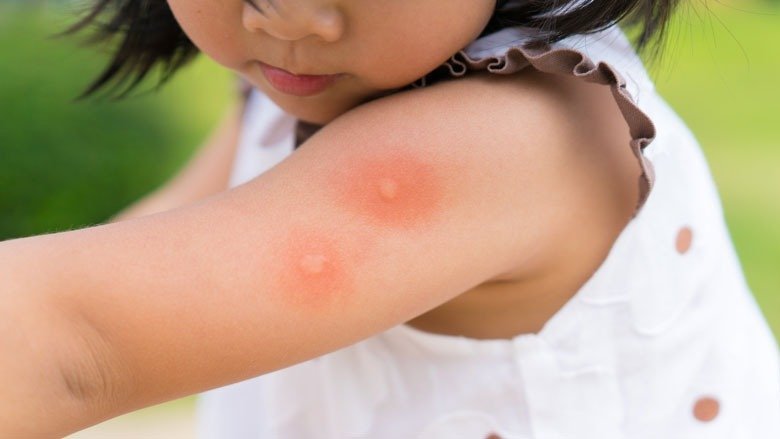 夏季驱蚊大作战 | 纱窗、花露水、蚊香、防蚊止痒神器... 这些驱蚊方法安全高效！