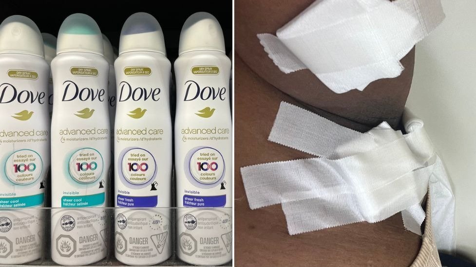 Dove产品又出事！喷雾式除臭剂导致腋下长囊肿，多名受害者分享痛苦经历！