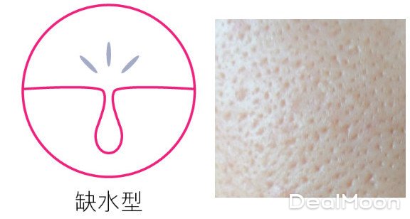 毛孔粗大问题:小姐!你的脸好像苏打饼干!-北美省钱快报攻略