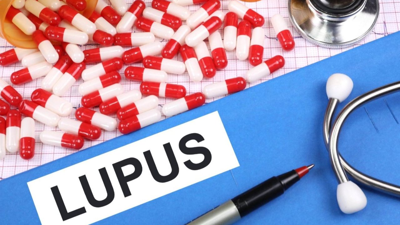 红斑狼疮攻略 - Lupus高发患病人群、症状表现、病因