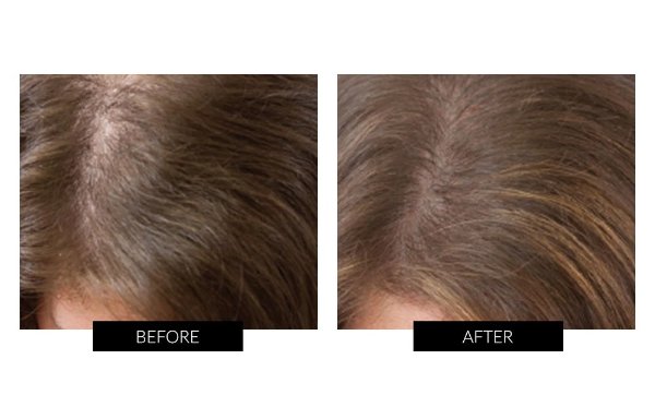 iGrow Laser Hair Rejuvenation System