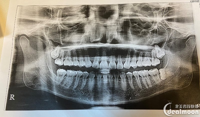 医生给我拍了片,发现我有三颗智齿,包括一颗horizontal impacted