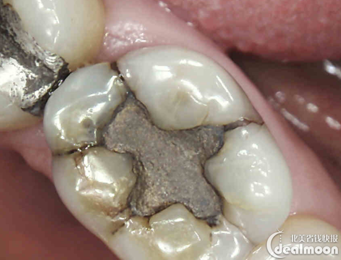 做银汞合金的补牙                    构.如果本身蛀牙很小,做银