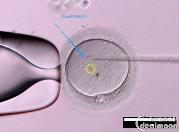 icsi 单精子显微注射版权属于fst诊所