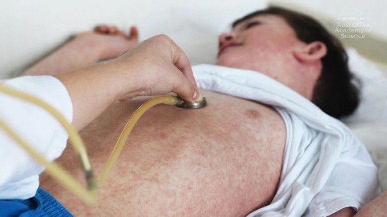 澳洲境内两例新麻疹传染病例！卫生部督促旅行者自查和接种预防疫苗！
