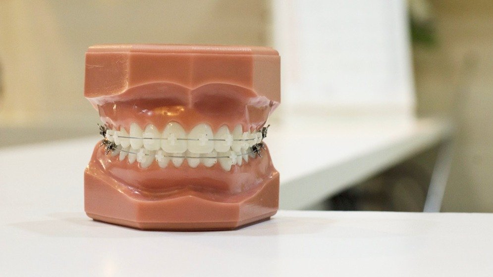 加拿大牙齿矫正攻略 - 牙套种类+整牙费用+保险问题