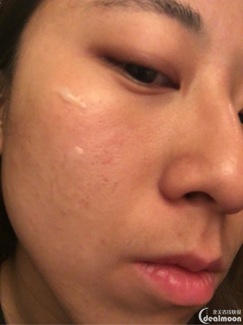 因为 闭口,皮肤坑坑洼洼,还有很多小红痘印.