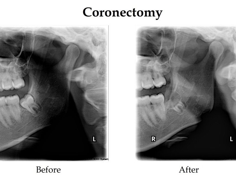在美补牙，全麻拔智齿，以及智齿手术Coronectomy简介