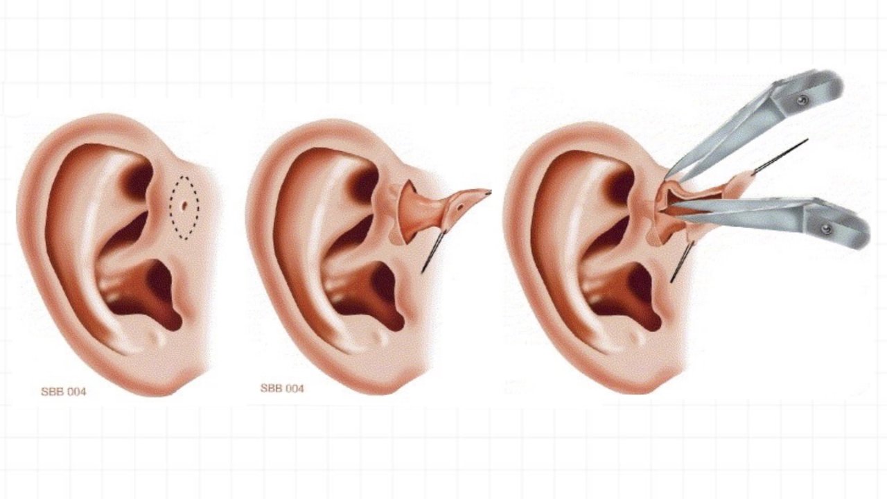 儿童先天性耳前瘘管感染摘除手术