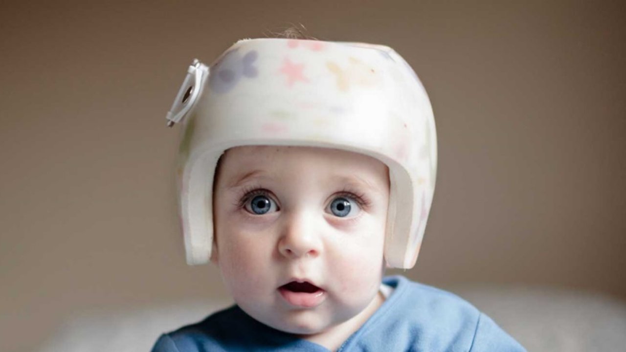 宝宝扁平头flat head戴头盔🪖｜怎样知道宝宝需不需要戴头盔