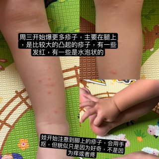 炎炎夏日战胜手足口病‼️娃病程和应对措施...