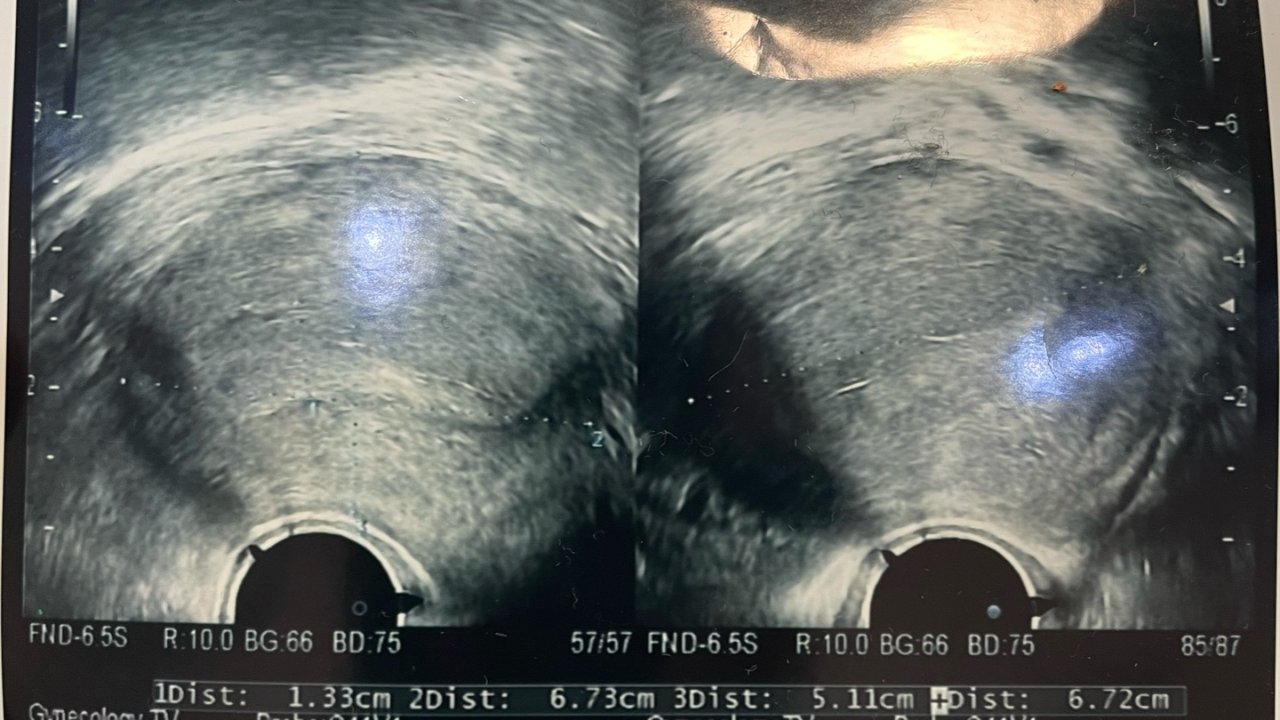IUD Mirena 曼月乐 避孕环中美上环比较及上环后1个月症状
