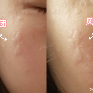 护肤经验｜预防寒冷性荨麻疹和皮肤健康修复...