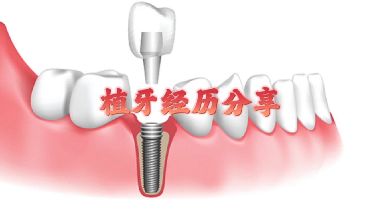 植牙经历分享 (Dental Implant)