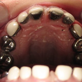 Teeth 101 美国牙冠的种类和选择...