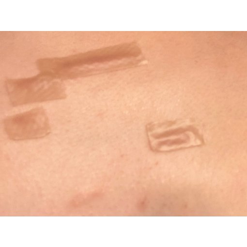 来自蟹足肿患者的真实测评 之 Dimora硅胶疤痕贴