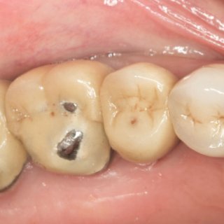 Teeth 101 美国牙冠的种类和选择...