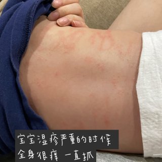 宝宝👶🏻湿疹或易敏感肌肤皮肤日常护理｜大...