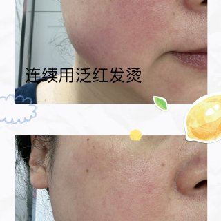 玫瑰皮如何正确使用巴库乔尔灌浆精华...