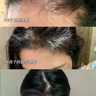 产后 9 个月｜我的发际线终于救回来了✨...