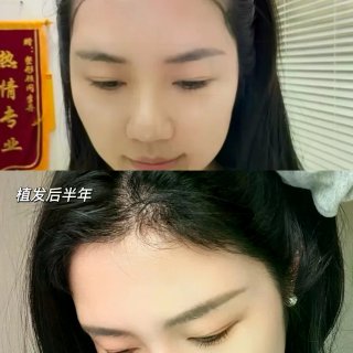 产后 9 个月｜我的发际线终于救回来了✨...
