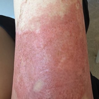 烫伤医生推荐的恢复期用的“凡士林”...