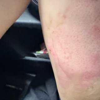 烫伤修复最后阶段...