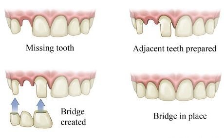 局麻植牙是怎样一种体验。附带一些关于牙齿护理的小贴士。-北美省钱 