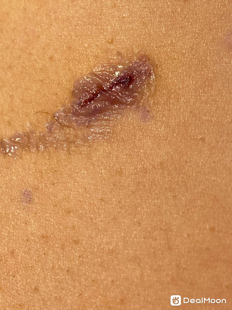 Incision4_guyuqin11232020.jpg