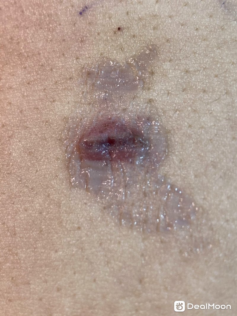 Incision1_2_guyuqin11232020.jpg