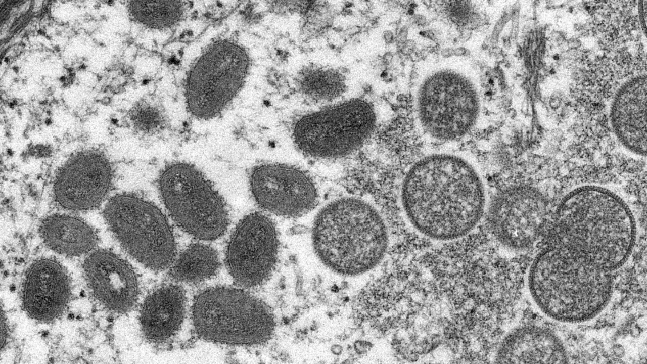 美国猴痘病例增至45例，CDC表示近期猴痘病例症状与以往不一样