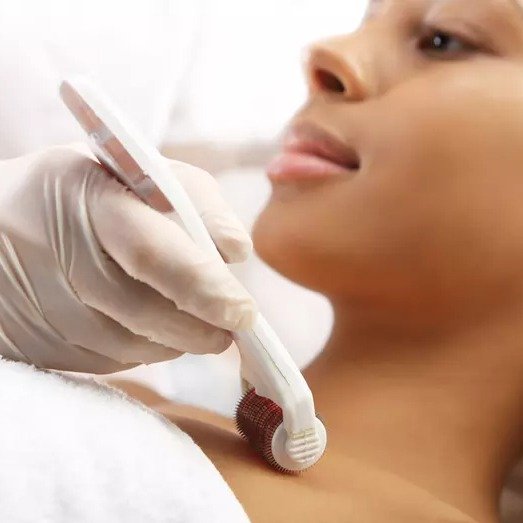 $149 for One Platelet-Rich Plasma Microneedling Facial at The Skin Agency ($149 Value)