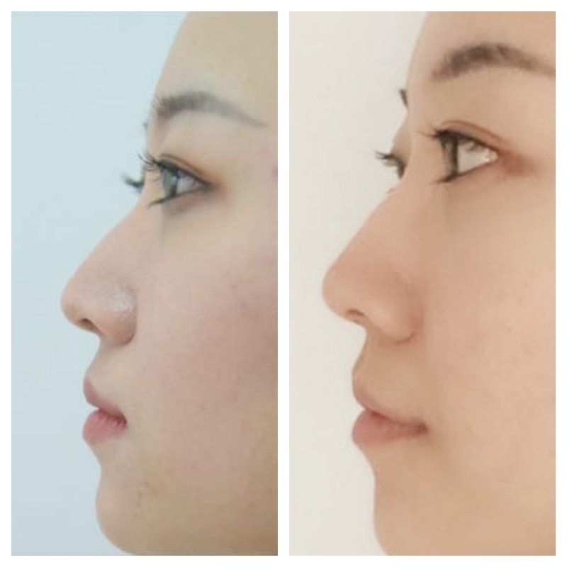 Filler Before After