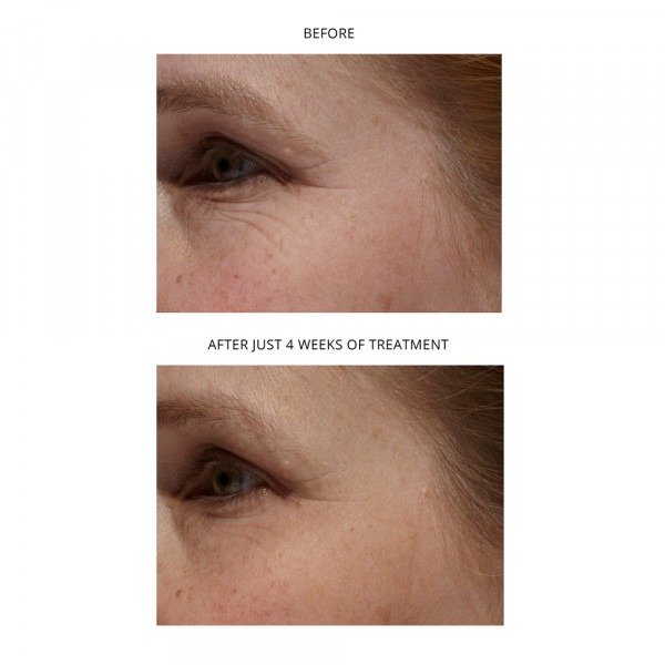 Age-Defying Eye Wrinkle Correcting Laser