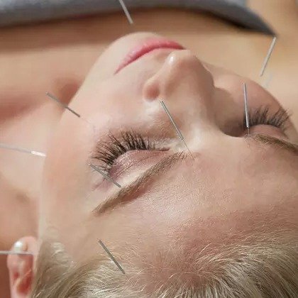 One Acupuncture Treatments & Consultation
