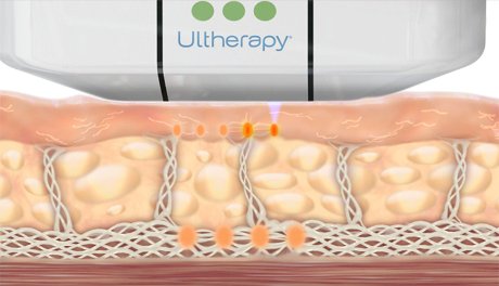 Animation_of_How_Ultherapy_Stimulates_Collagen_Production_at_Different_Layers_Skin_Tightening.jpg