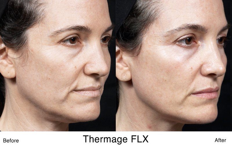 Thermage B&A