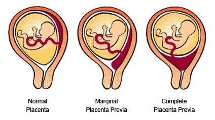孕期区分正常水肿和异常水肿，胎盘前置5大注意，常见不适与用药大百科