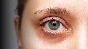 【祛黑眼圈眼霜推荐】色素型、血管型、结构型黑眼圈对症下药