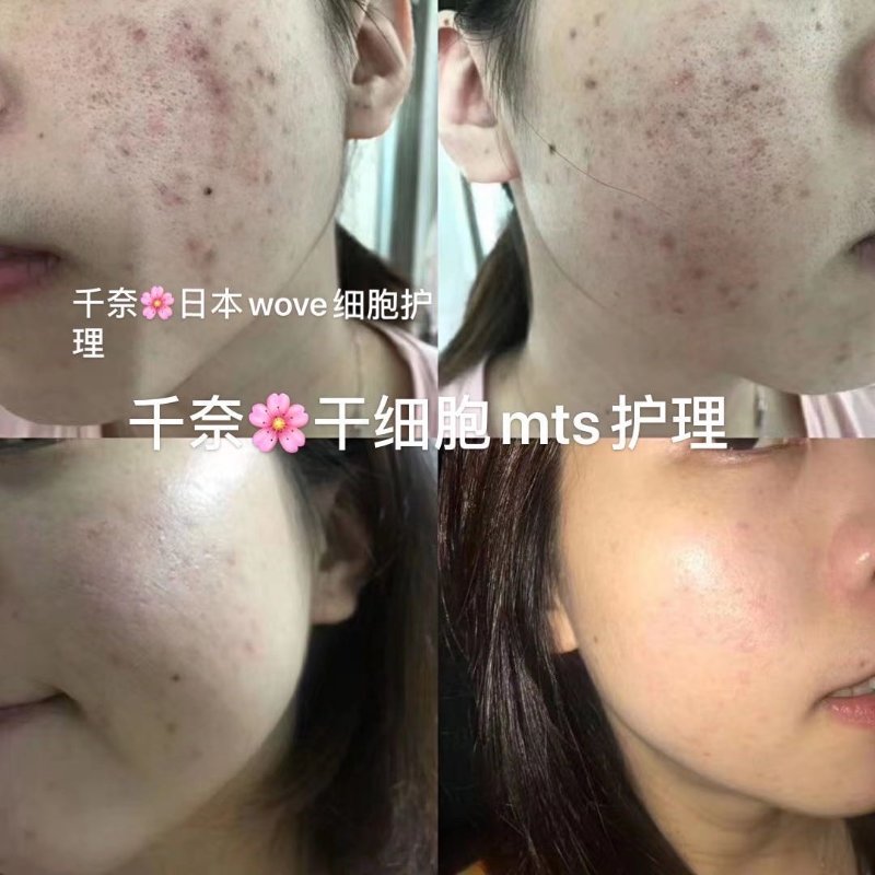 干细胞mts护理