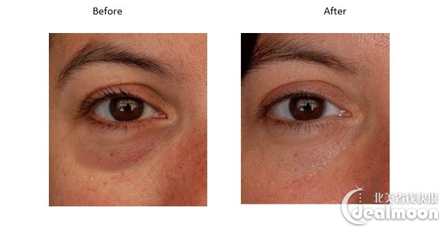lower-eyelid-rejuvenation-img7.jpg